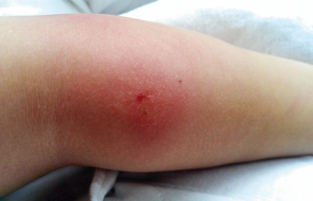 Example 1 of an infected insect bite