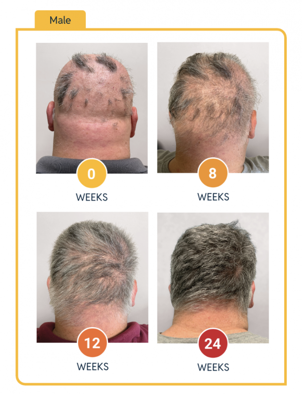 Leqselvi hair growth in a man over 24 weeks