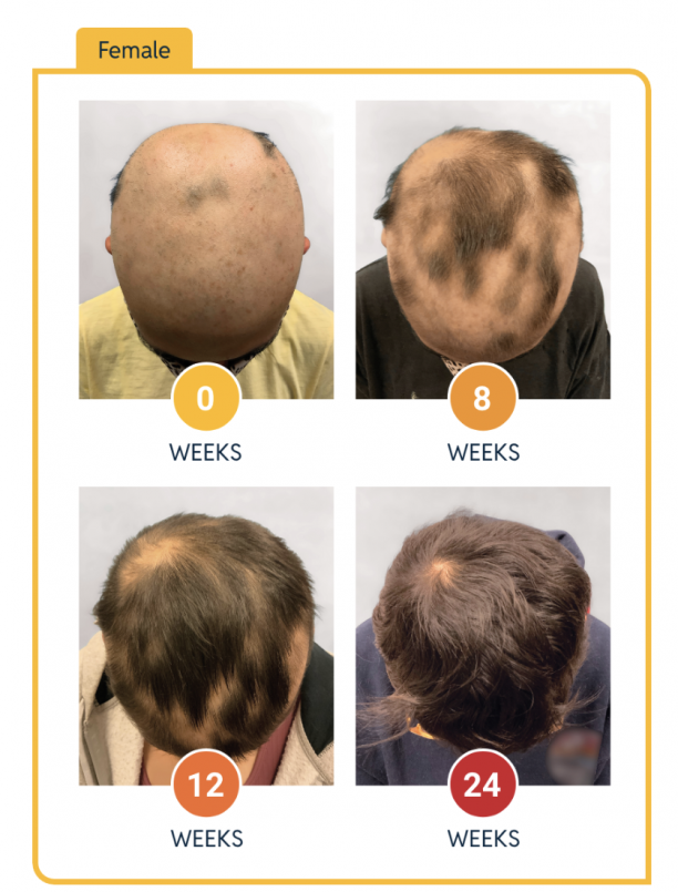 Leqselvi hair growth in a women over 24 weeks